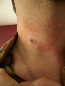 biopsy